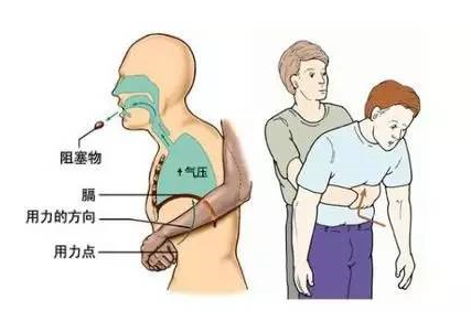 成人气管异物急救.png