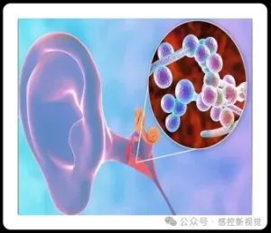 警惕超级真菌！耳念珠菌医院感染防控核心措施大揭秘